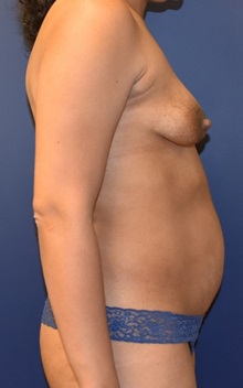 Tummy Tuck Before Photo by Richard Reish, MD, FACS; New York, NY - Case 30778