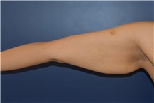 Arm Lift Before Photo by Richard Reish, MD, FACS; New York, NY - Case 30791