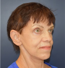 Facelift After Photo by Richard Reish, MD, FACS; New York, NY - Case 30794