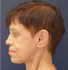 Facelift After Photo by Richard Reish, MD, FACS; New York, NY - Case 30794