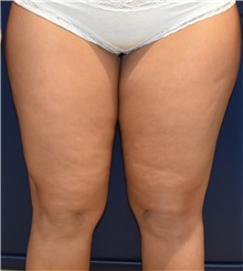 Liposuction Before Photo by Richard Reish, MD, FACS; New York, NY - Case 30796