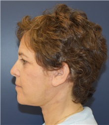 Facelift After Photo by Richard Reish, MD, FACS; New York, NY - Case 30797