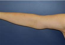 Arm Lift After Photo by Richard Reish, MD, FACS; New York, NY - Case 30798
