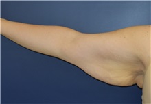 Arm Lift Before Photo by Richard Reish, MD, FACS; New York, NY - Case 30798