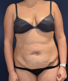 Tummy Tuck Before Photo by Richard Reish, MD, FACS; New York, NY - Case 30799