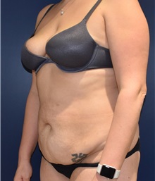 Tummy Tuck Before Photo by Richard Reish, MD, FACS; New York, NY - Case 30799