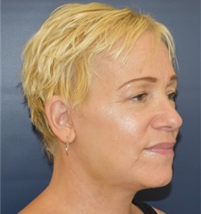 Facelift After Photo by Richard Reish, MD, FACS; New York, NY - Case 30801