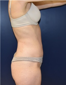Tummy Tuck After Photo by Richard Reish, MD, FACS; New York, NY - Case 30816