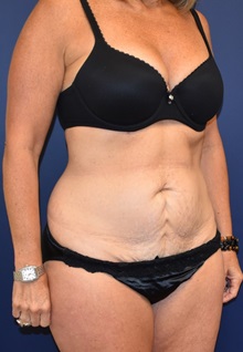 Tummy Tuck Before Photo by Richard Reish, MD, FACS; New York, NY - Case 30819