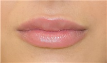 Lip Augmentation / Enhancement After Photo by Richard Reish, MD, FACS; New York, NY - Case 30820