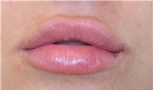 Lip Augmentation / Enhancement After Photo by Richard Reish, MD, FACS; New York, NY - Case 30821
