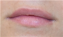 Lip Augmentation / Enhancement Before Photo by Richard Reish, MD, FACS; New York, NY - Case 30821