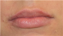 Lip Augmentation / Enhancement After Photo by Richard Reish, MD, FACS; New York, NY - Case 30822