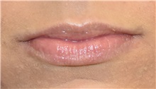 Lip Augmentation / Enhancement Before Photo by Richard Reish, MD, FACS; New York, NY - Case 30822