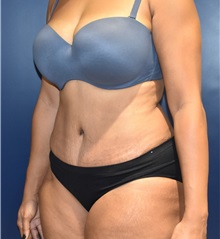 Tummy Tuck After Photo by Richard Reish, MD, FACS; New York, NY - Case 30824