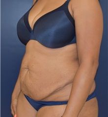 Tummy Tuck Before Photo by Richard Reish, MD, FACS; New York, NY - Case 30824
