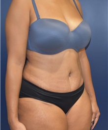 Tummy Tuck After Photo by Richard Reish, MD, FACS; New York, NY - Case 30824