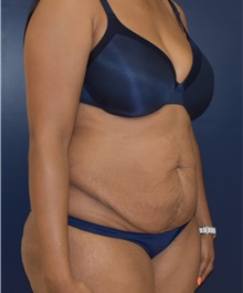 Tummy Tuck Before Photo by Richard Reish, MD, FACS; New York, NY - Case 30824