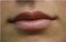 Lip Augmentation / Enhancement Before Photo by Richard Reish, MD, FACS; New York, NY - Case 30826