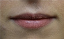 Lip Augmentation / Enhancement Before Photo by Richard Reish, MD, FACS; New York, NY - Case 30827