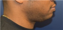 Chin Augmentation Before Photo by Richard Reish, MD, FACS; New York, NY - Case 30828