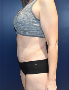 Tummy Tuck After Photo by Richard Reish, MD, FACS; New York, NY - Case 30829