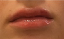 Lip Augmentation / Enhancement After Photo by Richard Reish, MD, FACS; New York, NY - Case 30831