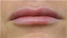 Lip Augmentation / Enhancement After Photo by Richard Reish, MD, FACS; New York, NY - Case 30832