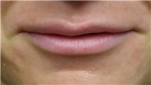 Lip Augmentation / Enhancement Before Photo by Richard Reish, MD, FACS; New York, NY - Case 30832