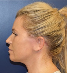 Facelift After Photo by Richard Reish, MD, FACS; New York, NY - Case 30835
