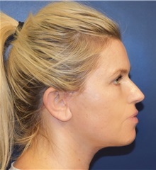 Facelift After Photo by Richard Reish, MD, FACS; New York, NY - Case 30835