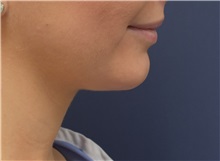 Chin Augmentation After Photo by Richard Reish, MD, FACS; New York, NY - Case 30836