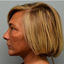 Facelift After Photo by Richard Reish, MD, FACS; New York, NY - Case 30837