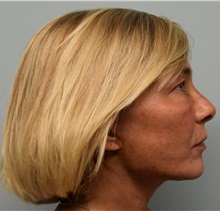 Facelift After Photo by Richard Reish, MD, FACS; New York, NY - Case 30837