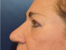 Eyelid Surgery After Photo by Richard Reish, MD, FACS; New York, NY - Case 30890