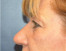 Eyelid Surgery Before Photo by Richard Reish, MD, FACS; New York, NY - Case 30890