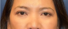 Eyelid Surgery After Photo by Richard Reish, MD, FACS; New York, NY - Case 30891
