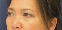 Eyelid Surgery Before Photo by Richard Reish, MD, FACS; New York, NY - Case 30891