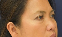 Eyelid Surgery Before Photo by Richard Reish, MD, FACS; New York, NY - Case 30891