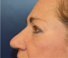 Eyelid Surgery After Photo by Richard Reish, MD, FACS; New York, NY - Case 30923