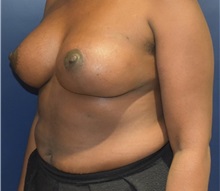 Breast Augmentation After Photo by Richard Reish, MD, FACS; New York, NY - Case 30929