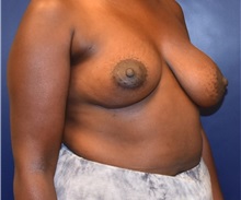 Breast Augmentation Before Photo by Richard Reish, MD, FACS; New York, NY - Case 30929