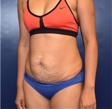 Tummy Tuck Before Photo by Richard Reish, MD, FACS; New York, NY - Case 30932