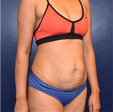 Tummy Tuck Before Photo by Richard Reish, MD, FACS; New York, NY - Case 30932