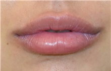 Lip Augmentation/Enhancement After Photo by Richard Reish, MD, FACS; New York, NY - Case 30933