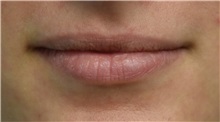 Lip Augmentation / Enhancement Before Photo by Richard Reish, MD, FACS; New York, NY - Case 30934