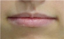Lip Augmentation / Enhancement Before Photo by Richard Reish, MD, FACS; New York, NY - Case 30935