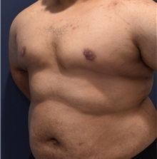Male Breast Reduction After Photo by Richard Reish, MD, FACS; New York, NY - Case 30937