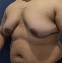 Male Breast Reduction Before Photo by Richard Reish, MD, FACS; New York, NY - Case 30937