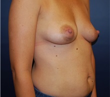 Breast Augmentation Before Photo by Richard Reish, MD, FACS; New York, NY - Case 30938